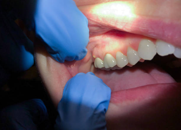 Best Emergency Treatment for Oral Infections in North New Hyde Park, NY